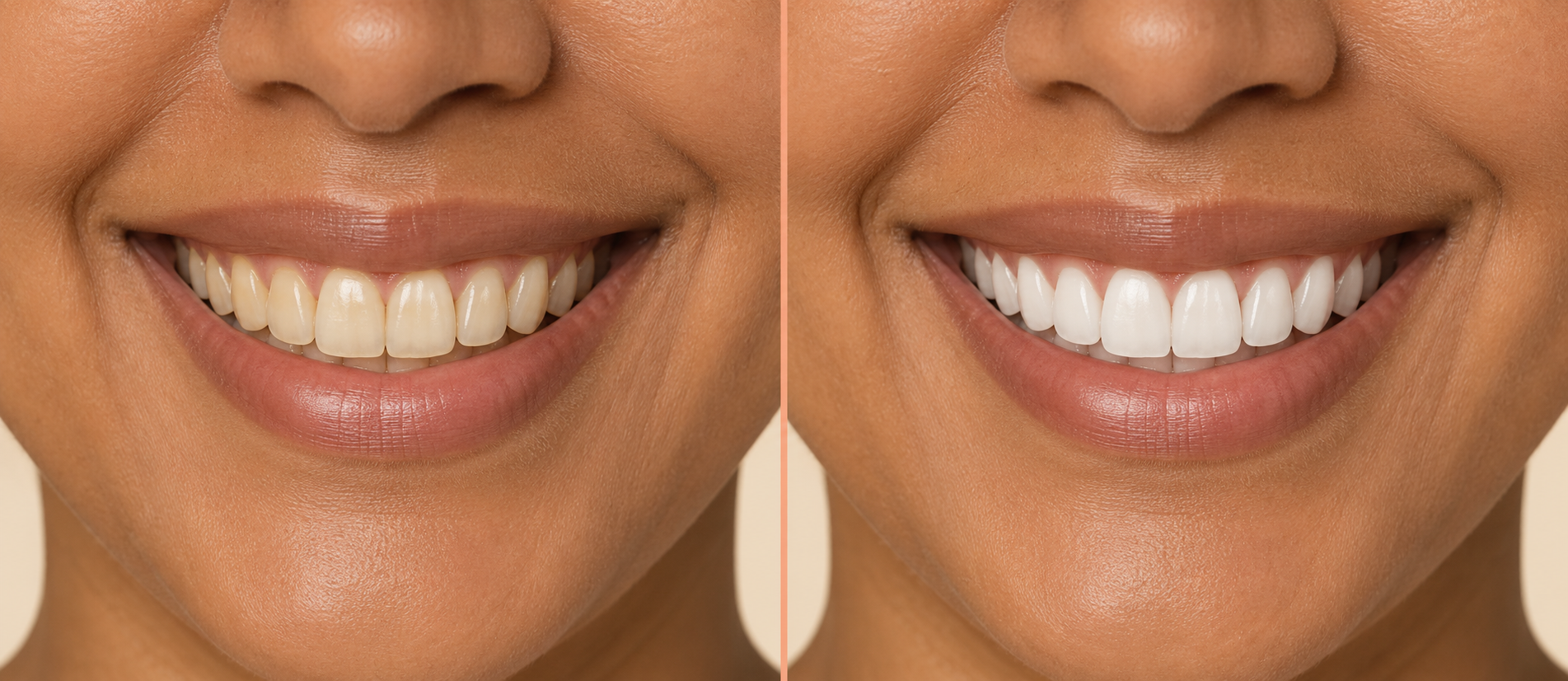 SmilePop client smile before and after a teeth whitening session, visibly brighter teeth